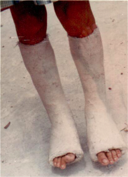 [ Ginger with Casts ]